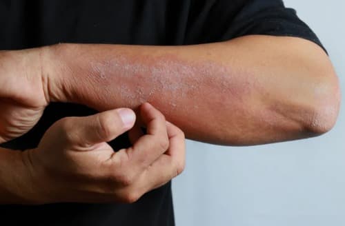 Eczemaron कीमत क्या है